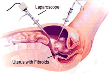 Laparoscopic Surgery for Fibroids in Jalandhar